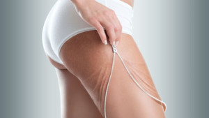 cellulite femme cuisse