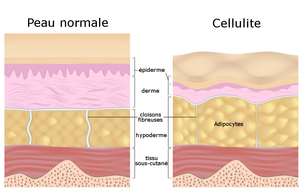 schéma de la cellulite