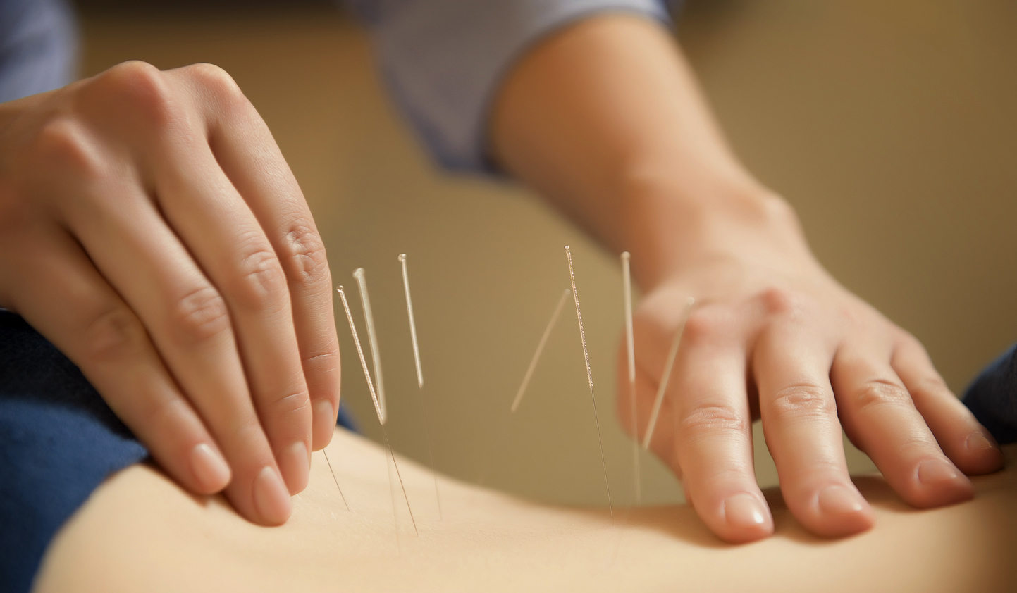 acupuncture pour maigrir