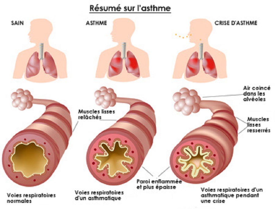 asthme-resume